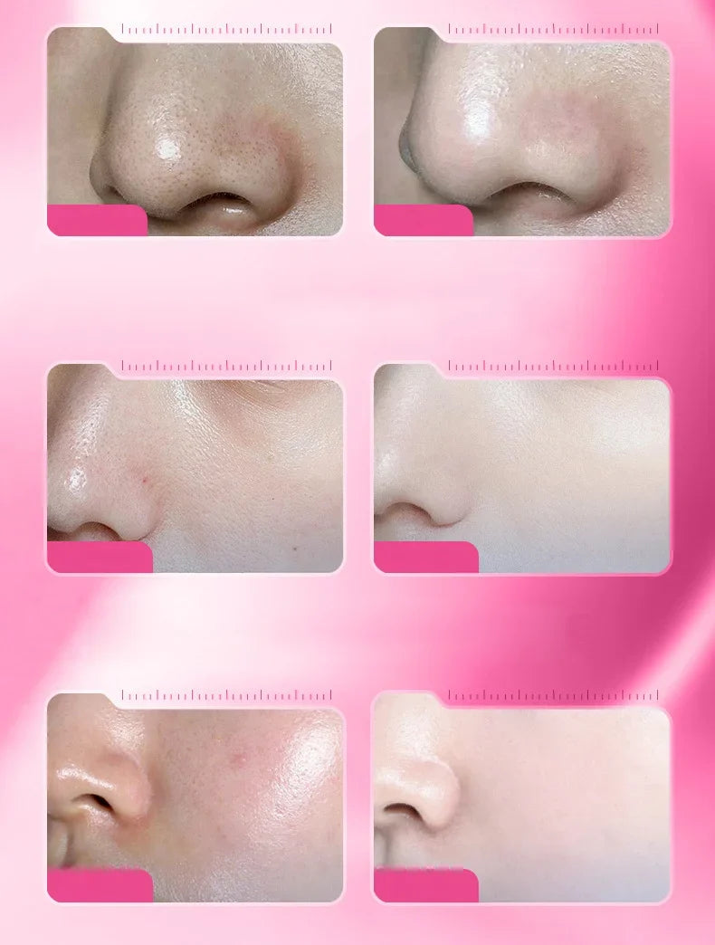 100ml Pink Salicylic Acid Acne Removing Concentrated essence - Refreshing texture, deep moisturizing, fade acne marks