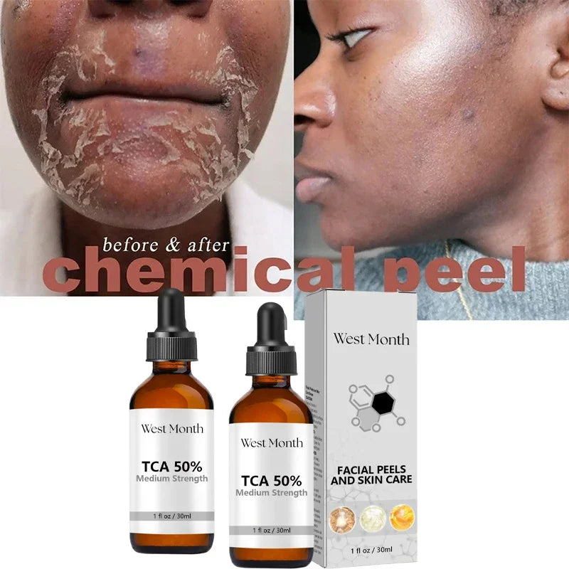 Acid Peeling Serum Chemical Exfoliant Peel For Remove Face Dark Skin Spots Whiten Lighten Melanin Peeling Solution Skin Peel