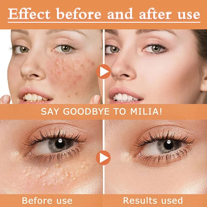 Fat Granules Removal Eye Serum Eye Milia Repair Treatment Products Wrinkle Lifting Moisturizing Anti-Puffiness Korean Skin Care